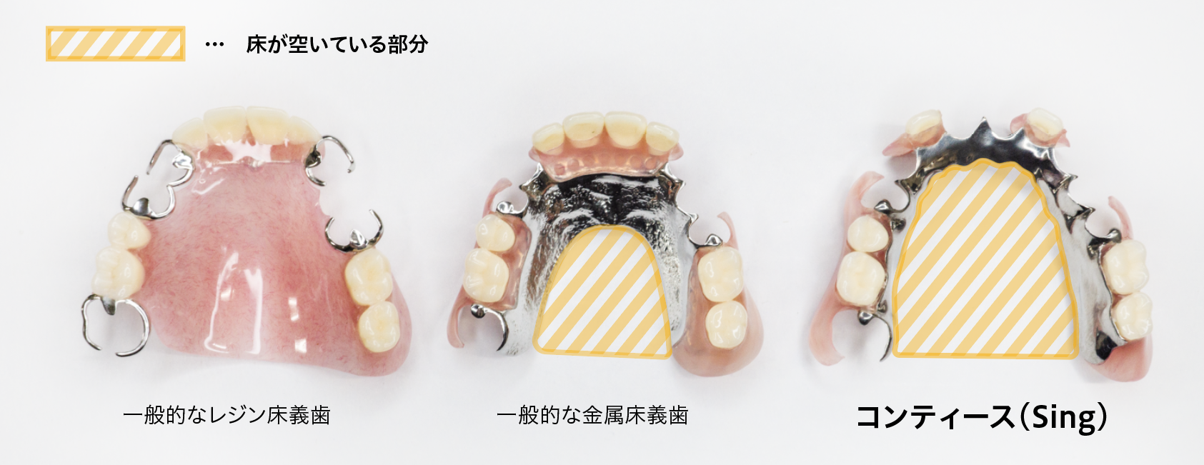 一般的なレジン床義歯・金属床義歯・コンティースの口腔内側面積の比較